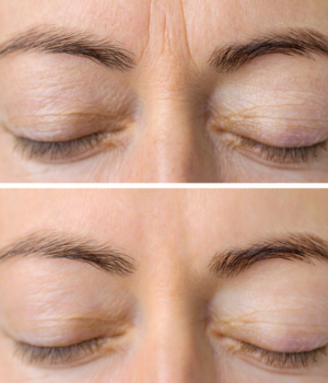 Botox Clinica Estetica Bella Forma